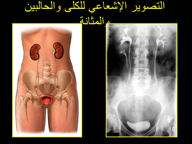 التصوير الإشعاعي للكلى والحالبين والمثانة